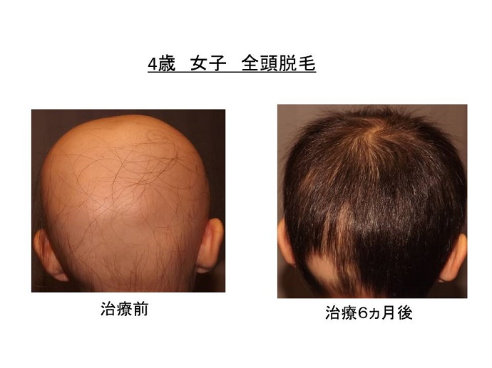 円形脱毛症　病院""